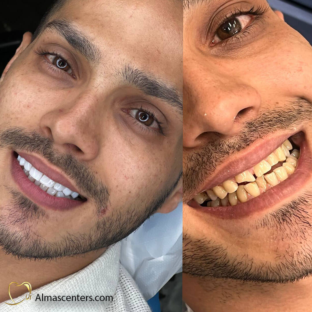 نمونه انجام شده کامپوزیت ونیر برای مراجعه کننده