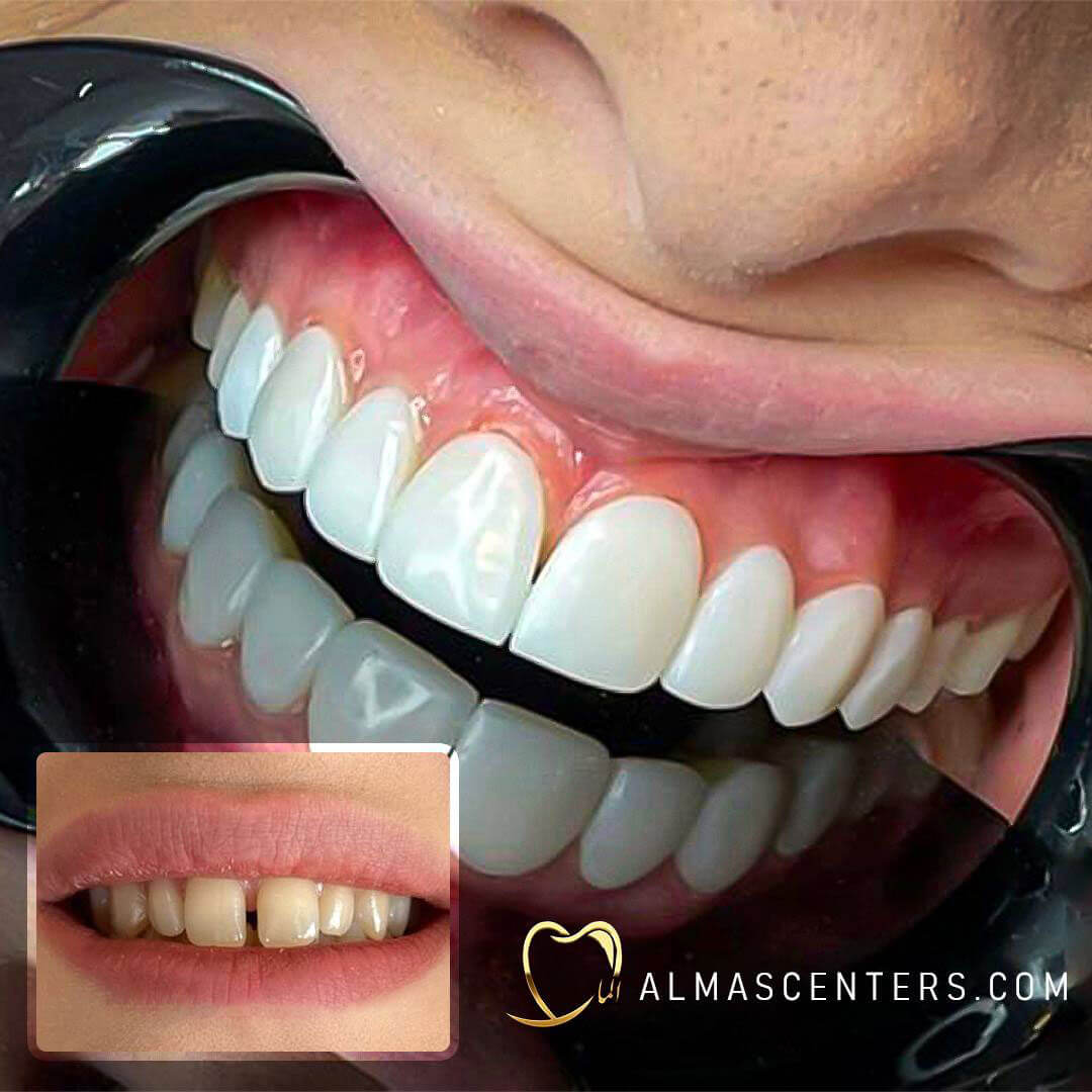 نمونه کامپوزیت ونیر