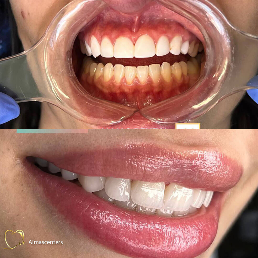 نمونه لمینیت سرامیکی انجام شده در مرکز دندانپزشکی الماس