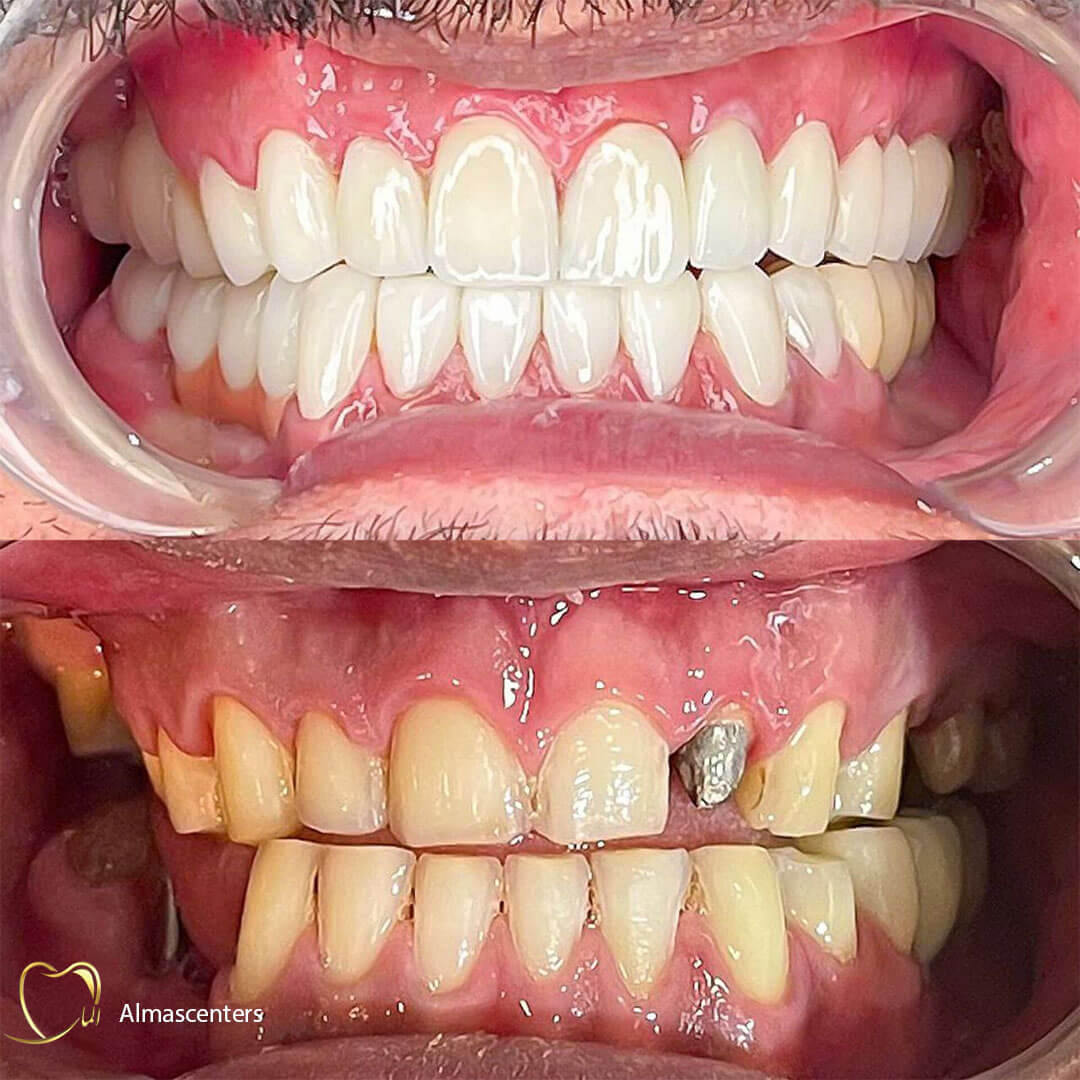 نمونه لمینیت سرامیکی انجام شده در مرکز دندانپزشکی الماس