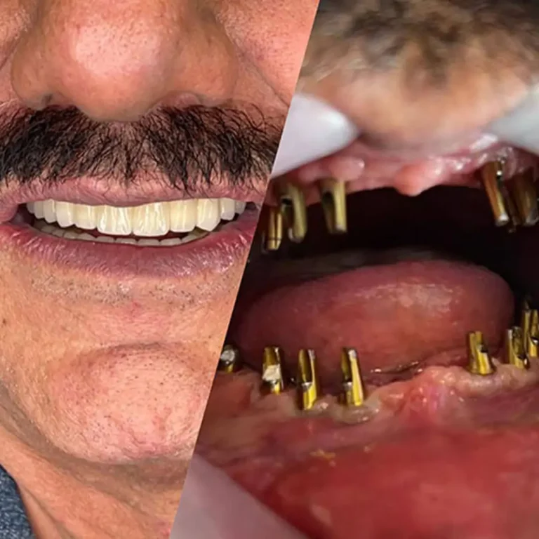 ایمپلنت دندان در شهریار با شرایط اقساطی در مرکز الماس