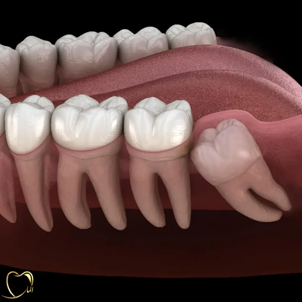 تصویر دندان عقل نهفته
