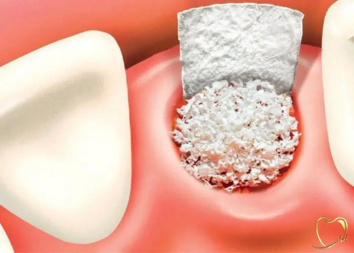 ساختار پودر استخوان در دندانپزشکی